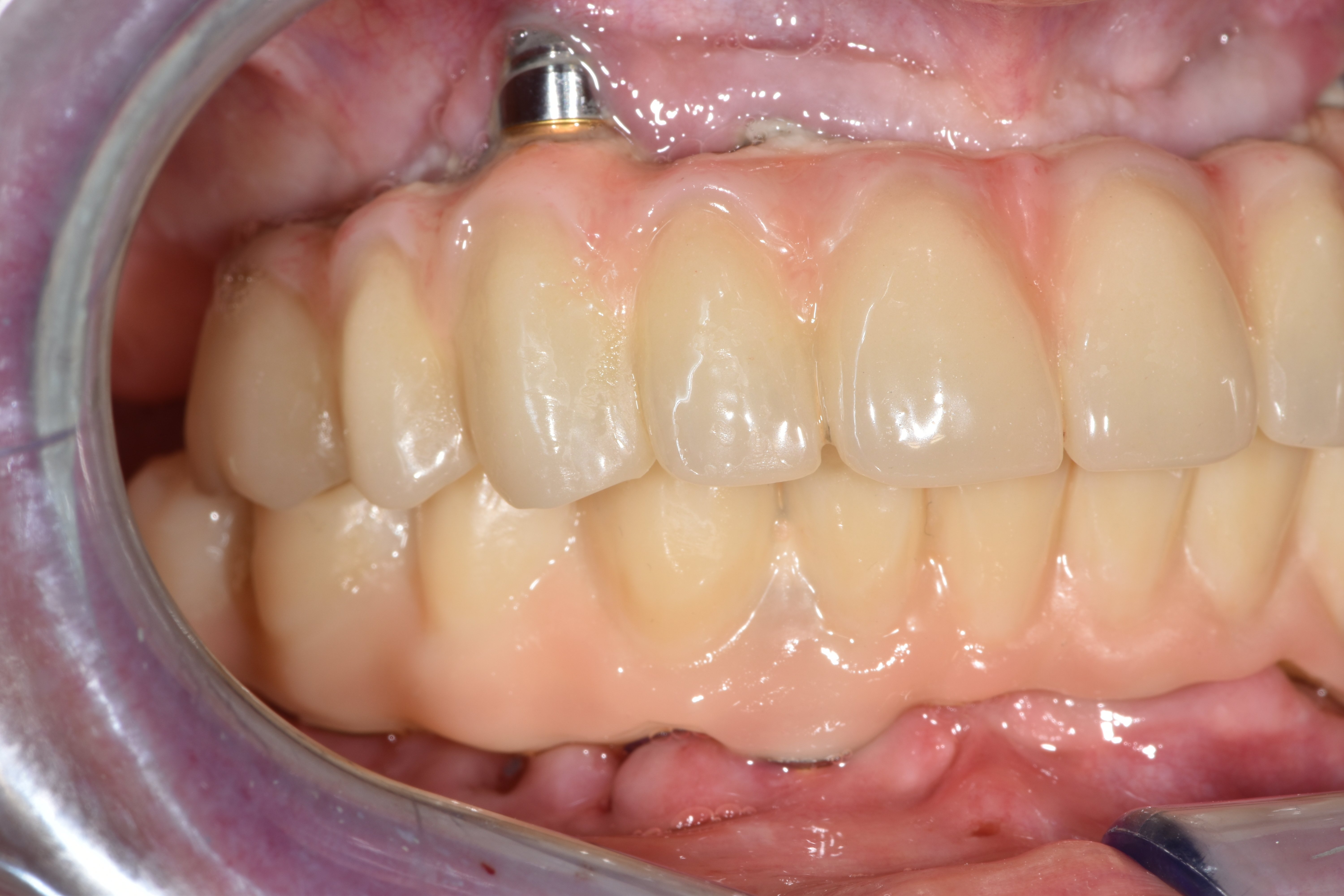 stampa 3d dentale