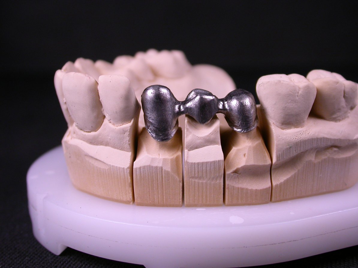 Staffe Metalliche Dentali Ortodontiche Da 100 Confezioni Staffa - Foto 5