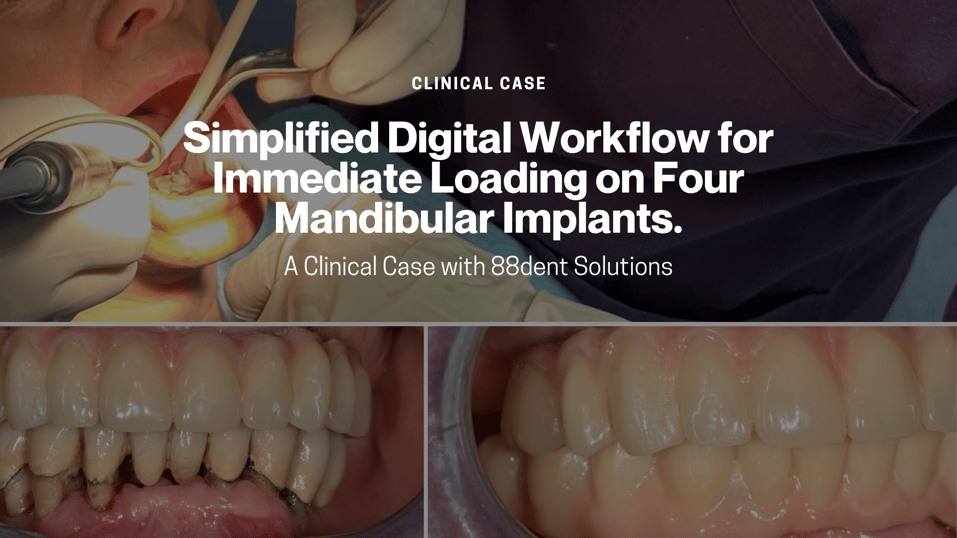 Simplified Digital Workflow for Immediate Loading on Four Mandibular Implants.