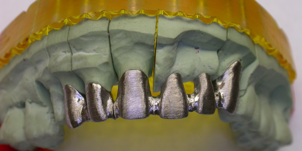 Modello Dentario Ortodontico Dei Denti Umani Con Gli Impianti, Ganci